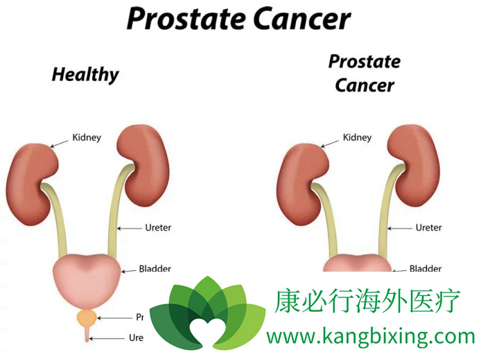 排尿困难是非常典型的早期前列腺癌症状