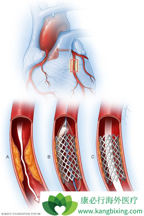 进口心脏支架都少钱 心脏支架术后吃什么