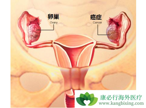 卵巢癌的早期症状图片