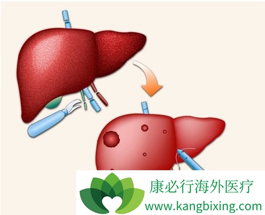 得了丙肝有什麼症狀【康必行海外醫療】