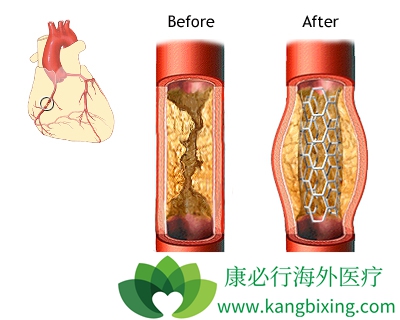 做心臟支架的好與壞 心臟搭橋和支架有區別嗎