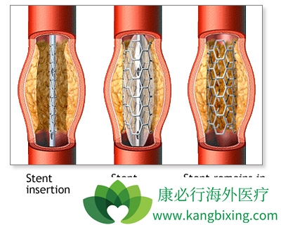 心脏支架