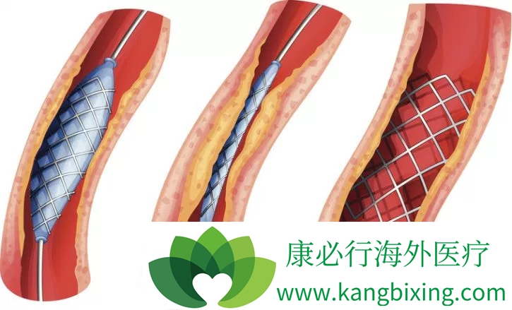 心脏支架