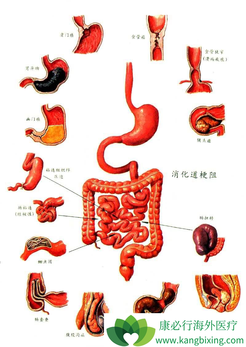 腫瘤資訊 為什麼消化道腫瘤檢測出來大多數是晚期 大家知道,消化系統